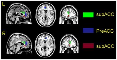 Aberrant functional connectivity in anterior cingulate gyrus subregions in migraine without aura patients